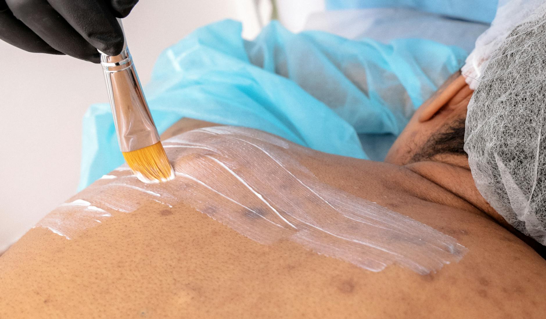 Close-up of a beautician applying treatment to a man's back in a spa. - natural acne treatment
